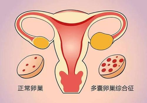 姜瑞雪教授：多囊卵巢综合征月经不调中医怎么调理？