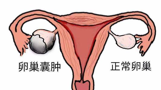 卵巢囊肿腰酸小腹疼痛治疗方法
