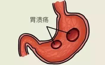 胃溃疡症状