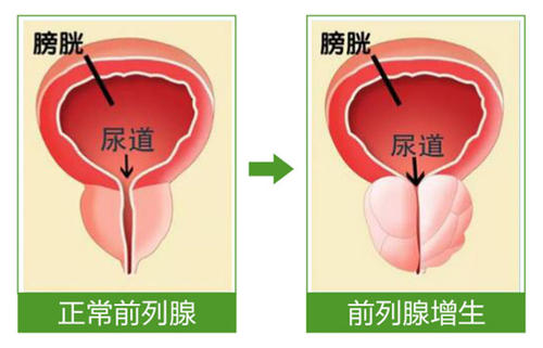 前列腺增生夜尿多排尿无力尿后滴沥怎么办？