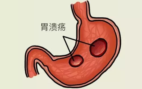 胃溃疡胃痛怎么治疗有效果？