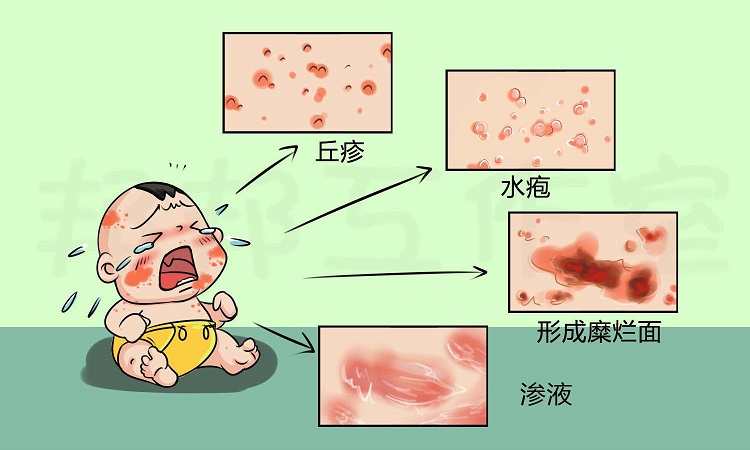 急性湿疹有哪些症状？