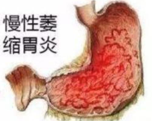 慢性萎缩性胃炎伴胃窦多发糜烂胃闷胀吃什么药？