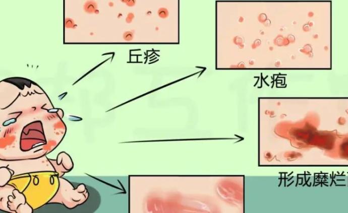 急性湿疹怎么快速处理？