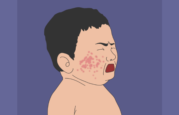 脸上过敏性湿疹怎么治疗？