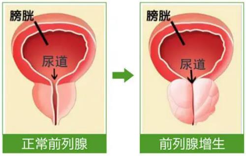 前列腺增生伴慢性前列腺炎会阴胀痛2年，腹痛腰酸尿不尽怎么办？