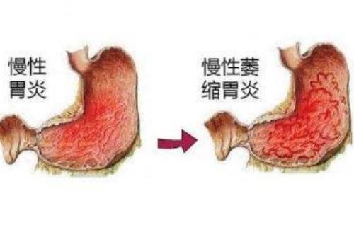 慢性萎缩性胃炎伴肠上皮化生，嘈杂口干苦怎么治疗好？