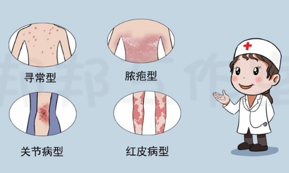 火毒炽盛型银屑病有哪些症状？