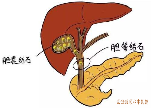 胆石症中医治疗医案