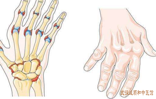 手指类风湿关节炎中医可以治疗吗？