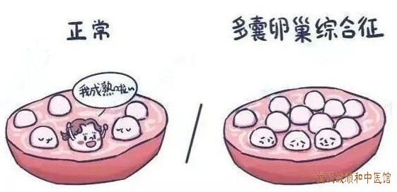 武汉妇科门诊专家姜瑞雪教授：20岁女性因多囊卵巢多囊卵巢综合征闭经医案一则。