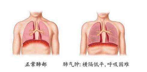 肺气肿