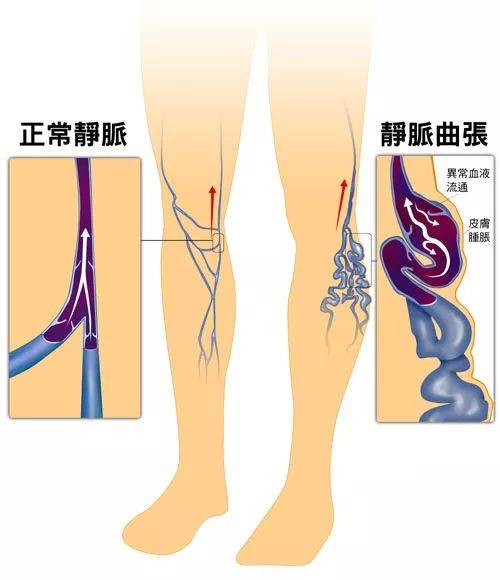 下肢静脉曲张青筋突起中医怎么治疗？