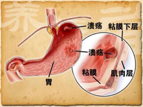 胃溃疡左上腹部疼痛反复发作担心变为癌症吃什么中药能治好？