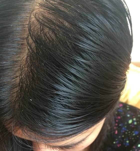 脂溢性脱发怎么治疗？