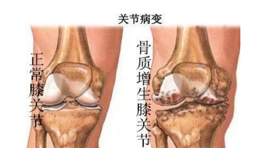 膝关节骨质增生怎么办？