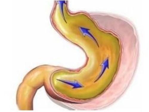 浅表性胃炎伴胆汁反流胃胀痛嘈杂的中药秘方