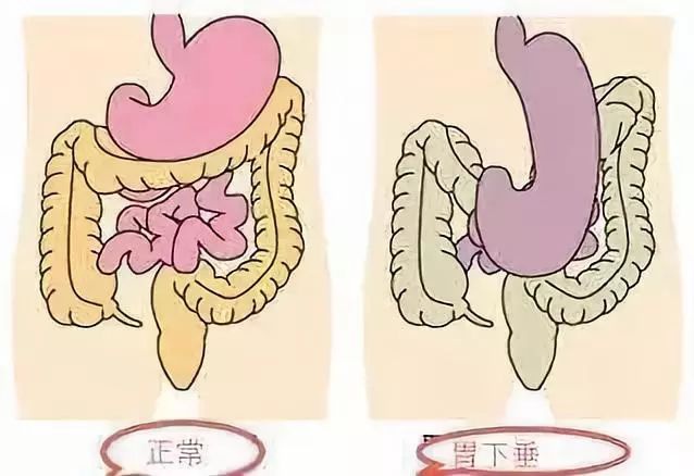 胃下垂有哪些症状？