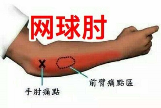 网球肘是怎么回事怎么治疗？