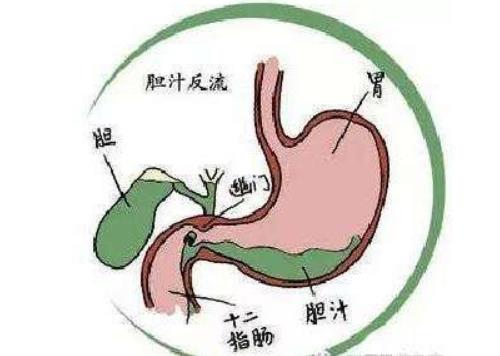 胆汁返流性食管炎泛酸胃烧灼反复发作3年怎么办？