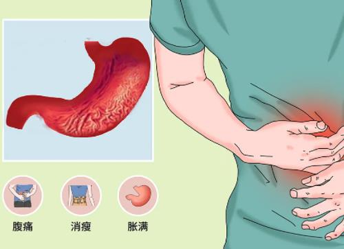 慢性萎缩性胃炎伴肠上皮化生医案