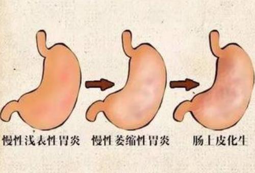 重度慢性萎缩性胃炎伴重度肠化反复胃痛用什么中药方能治好？