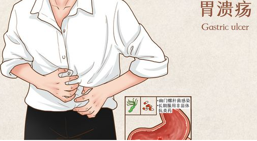 胃溃疡中医治疗医案