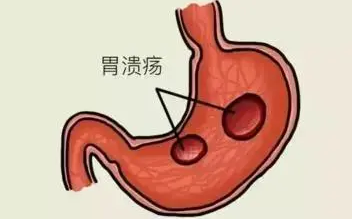 胃溃疡怎么治疗？