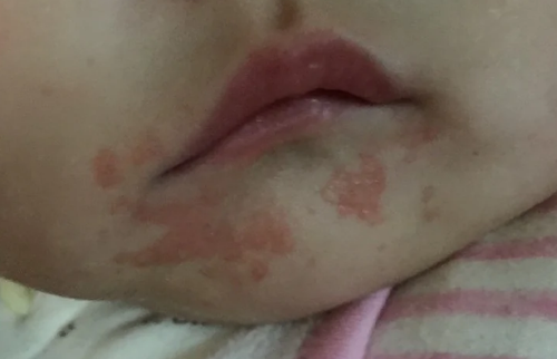 嘴巴周围反复长红色小疙瘩是湿疹吗？中医怎么辨证用药治疗口周湿疹？