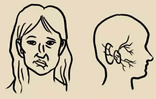 面神经炎导致面部无力口角下垂中医有什么好的治疗方式病情可以恢复吗？
